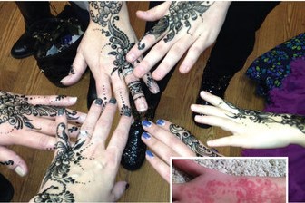 Los tatuajes de henna negra pueden ponerlo en peligro. (PRNewsfoto/U.S. Food and Drug Administrati)
